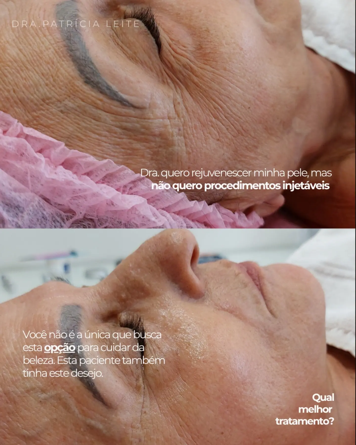 Rejuvenescimento de pele: antes e depois real publicado pela Dra. Patrícia