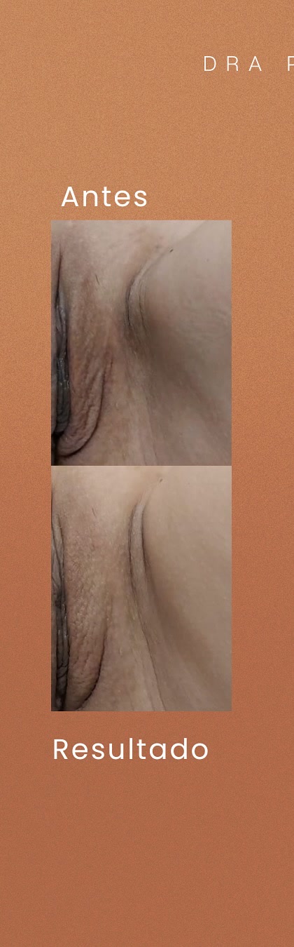 Preenchimento íntimo: antes e depois real publicado pela Dra. Patrícia