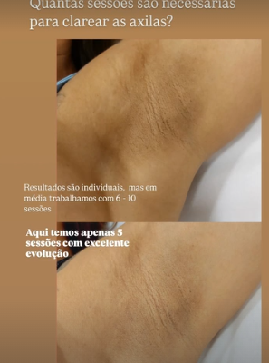 Clareamento: antes e depois real publicado pela Dra. Patrícia