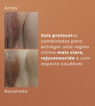 Clareamento e preenchimento íntimo: antes e depois real publicado pela Dra. Patrícia