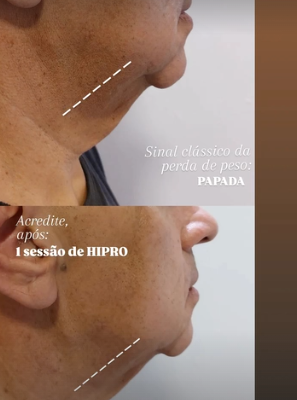 Contorno facial: antes e depois real publicado pela Dra. Patrícia