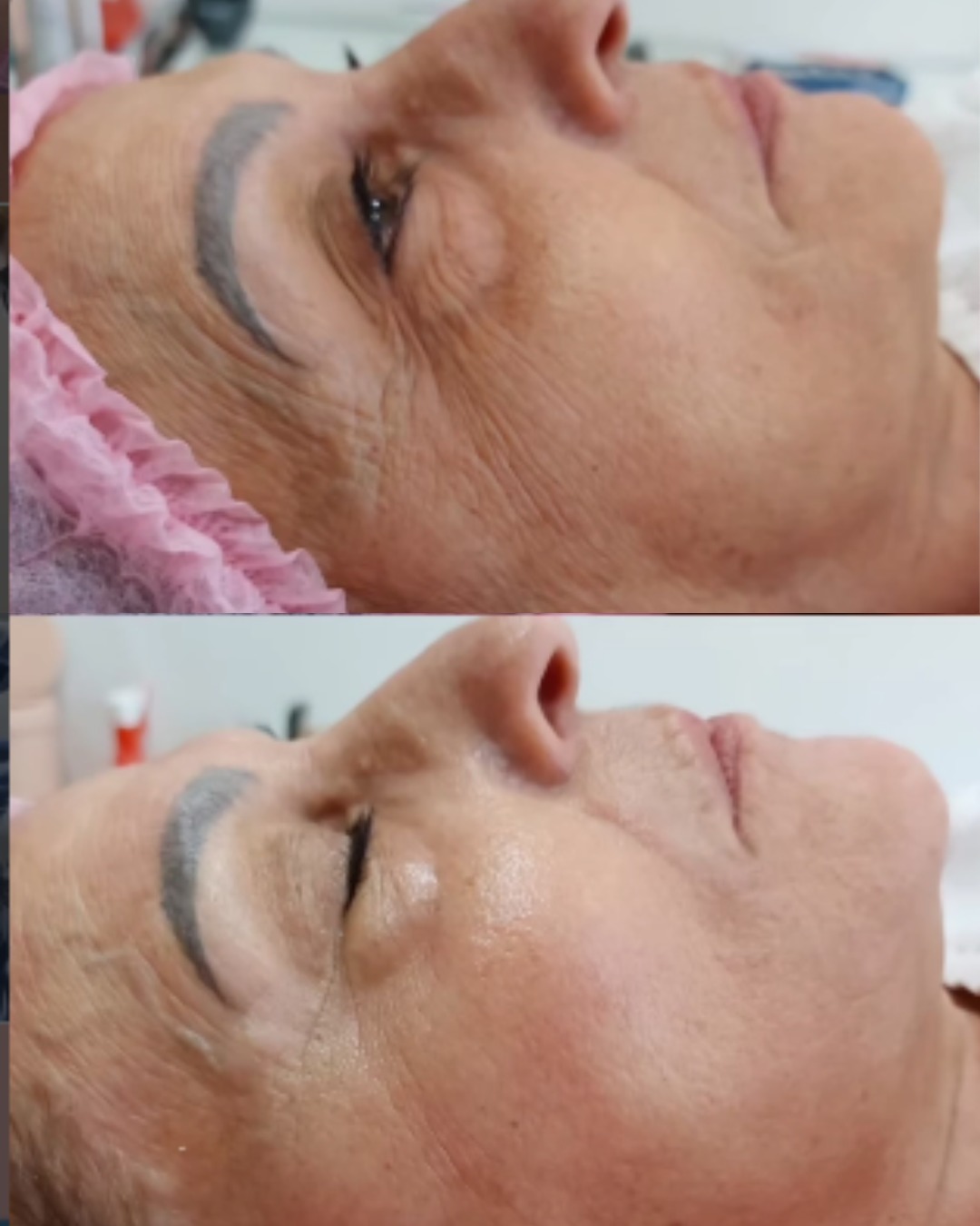 Tratamento regenerador cutâneo: antes e depois real publicado pela Dra. Patrícia